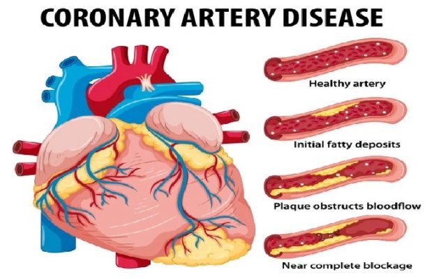 Coronary Artery Disease (CHD)