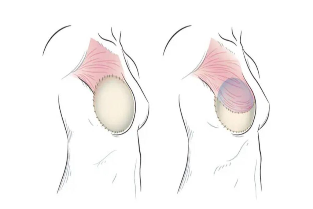 SIEA Flap Breast Reconstruction in Washington, DC